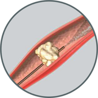 XFilter-Steps-2 XFilter-Steps-2